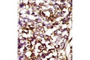 Formalin-fixed and paraffin-embedded human cancer tissue reacted with the primary antibody, which was peroxidase-conjugated to the secondary antibody, followed by AEC staining. (CDK4 Antikörper  (C-Term))