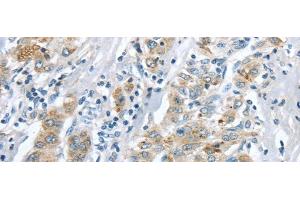 Immunohistochemistry of paraffin-embedded Human liver cancer tissue using LRP6 Polyclonal Antibody at dilution 1:60 (LRP6 Antikörper)
