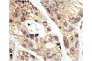 IHC analysis of FFPE human breast carcinoma tissue stained with the SUMO1 antibodyFITC-conjugated goat-anti-rabbit secondary Ab was used for the analysis. (SUMO1 Antikörper  (AA 1-30))