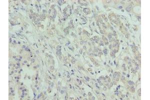 Immunohistochemistry of paraffin-embedded human pancreatic cancer using ABIN7144801 at dilution of 1:100 (ATXN7L1 Antikörper  (AA 1-146))