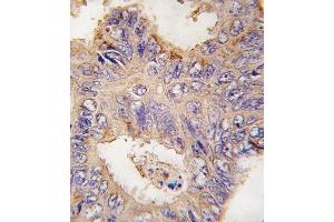 Formalin-fixed and paraffin-embedded human colon carcinoma tissue reacted with TRAF2 antibody (C-term) (ABIN392282 and ABIN2841948) , which was peroxidase-conjugated to the secondary antibody, followed by DAB staining. (TRAF2 Antikörper  (C-Term))