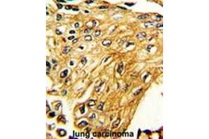 Formalin-fixed and paraffin-embedded human lung carcinoma reacted with IFNGR2 Antibody (C-term), which was peroxidase-conjugated to the secondary antibody, followed by DAB staining. (IFNGR2 Antikörper  (C-Term))