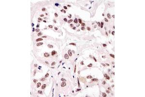 (ABIN387785 and ABIN2838022) staining SUMO1 in human breast carcinoma tissue sections by Immunohistochemistry (IHC-P - paraformaldehyde-fixed, paraffin-embedded sections). (SUMO1 Antikörper)