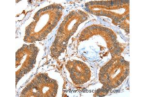 Immunohistochemistry of Human colon cancer using ACOT11 Polyclonal Antibody at dilution of 1:40 (ACOT11 Antikörper)