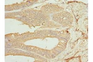 Immunohistochemistry of paraffin-embedded human endometrial cancer using ABIN7146875 at dilution of 1:100 (CSNK1G1 Antikörper  (Isoform gamma 1))