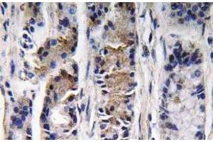 Immunohistochemistry (IHC) analyzes of Pepsin C antibody in paraffin-embedded human lung carcinoma tissue. (PGC Antikörper)