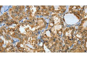 Immunohistochemistry of paraffin-embedded Human thyroid cancer using ANXA3 Polyclonal Antibody at dilution of 1:35 (Annexin A3 Antikörper)
