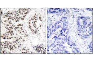 Immunohistochemistry analysis of paraffin-embedded human lung carcinoma, using Chk2 (Phospho-Thr68) Antibody. (CHEK2 Antikörper  (pThr68))