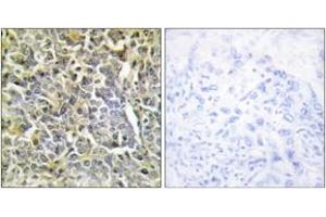 Immunohistochemistry analysis of paraffin-embedded human lung carcinoma tissue, using Collagen VI alpha2 Antibody. (COL6A2 Antikörper  (AA 691-740))