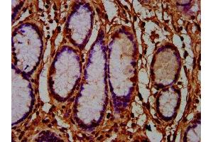 IHC image of ABIN7165044 diluted at 1:600 and staining in paraffin-embedded human gastric cancer performed on a Leica BondTM system. (AMN Antikörper  (AA 25-163))