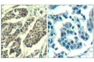 Immunohistochemical analysis of paraffin-embedded human breast carcinoma tissue using Cyclin B1 (phospho-Ser147) Antibody (E011540). (Cyclin B1 Antikörper  (pSer147))