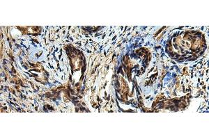 Immunohistochemistry of paraffin-embedded Human prost at e cancer tissue using TBCC Polyclonal Antibody at dilution of 1:80(x200) (TBCC Antikörper)