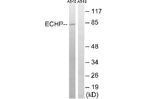 Immunohistochemistry analysis of paraffin-embedded human breast carcinoma tissue using EHHADH antibody. (EHHADH Antikörper  (Internal Region))