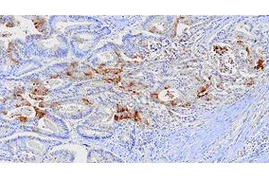 Paraffin embedded sections of human colon cancer tissue were incubated with FABP1 monoclonal antibody, clone 2G4  (1:100). (FABP1 Antikörper  (AA 1-127))