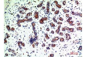 Immunohistochemistry (IHC) analysis of paraffin-embedded Human Breast Cancer, antibody was diluted at 1:200.