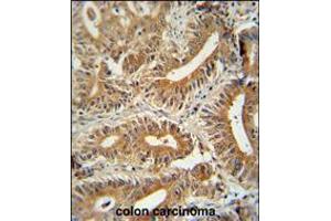 CCDC123 antibody immunohistochemistry analysis in formalin fixed and paraffin embedded human colon carcinoma followed by peroxidase conjugation of the secondary antibody and DAB staining. (CEP89 Antikörper  (C-Term))
