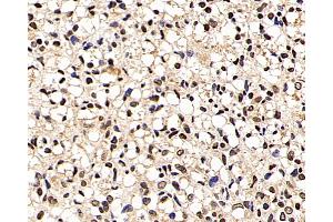 Immunohistochemistry analysis of paraffin-embedded human liver cancer using p27 Polyclonal Antibody at dilution of 1:200. (P27 Antikörper)