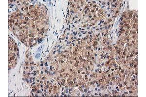Immunohistochemical staining of paraffin-embedded Adenocarcinoma of Human breast tissue using anti-DSTN mouse monoclonal antibody. (Destrin Antikörper)