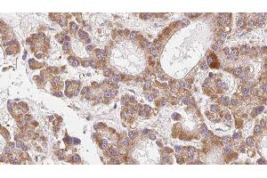 ABIN6279259 at 1/100 staining Human liver cancer tissue by IHC-P. (CEACAM20 Antikörper  (Internal Region))