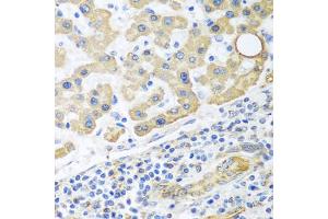 Immunohistochemistry of paraffin-embedded human liver cancer using GLUD1 antibody (ABIN5975614) at dilution of 1/100 (40x lens). (GLUD1 Antikörper)