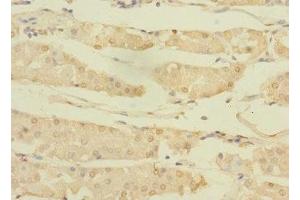 Immunohistochemistry of paraffin-embedded human gastric cancer using ABIN7144765 at dilution of 1:100 (ASTL Antikörper  (AA 38-337))