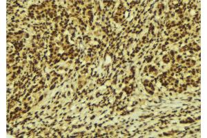 ABIN6269320 at 1/100 staining Human breast cancer tissue by IHC-P. (c-Rel Antikörper  (Internal Region))