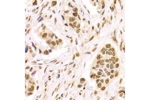 Immunohistochemistry of paraffin-embedded human breast cancer using HMGB1 Antibody. (HMGB1 Antikörper  (AA 100-200))