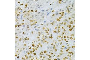 Immunohistochemistry of paraffin-embedded human liver cancer using DKC1 Antibody (ABIN5970956) at dilution of 1/200 (40x lens). (DKC1 Antikörper)