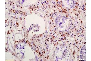 Formalin-fixed and paraffin embedded human colon carcinoma labeled with Anti-NFAT4 Polyclonal Antibody, Unconjugated (ABIN872596) at 1:200 followed by conjugation to the secondary antibody and DAB staining (CIDEC Antikörper  (AA 101-200))