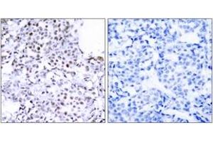 Immunohistochemistry analysis of paraffin-embedded human breast carcinoma tissue, using SMC1 (Ab-957) Antibody. (SMC1A Antikörper  (AA 931-980))
