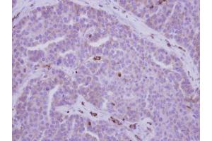 IHC-P Image Immunohistochemical analysis of paraffin-embedded human adenocarcinoma, using MYH9, antibody at 1:500 dilution. (Myosin 9 Antikörper  (N-Term))