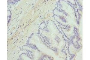 Immunohistochemistry of paraffin-embedded human prostate cancer using ABIN7149844 at dilution of 1:100 (DGKA Antikörper  (AA 1-200))