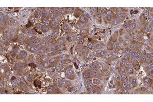 ABIN6273858 at 1/100 staining Human liver cancer tissue by IHC-P. (GPR161 Antikörper  (Internal Region))