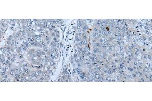 Immunohistochemistry of paraffin-embedded Human liver cancer tissue using NF1 Polyclonal Antibody at dilution of 1:65(x200) (Neurofibromin 1 Antikörper)