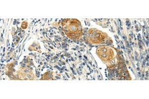 Immunohistochemistry of paraffin-embedded Human cervical cancer using MSI1 Polyclonal Antibody at dilution of 1/30 (MSI1 Antikörper)