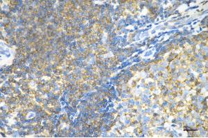 Immunohistochemistry was performed on paraffin-embedded human breast carcinoma using moesin antibody (ABIN7799482), 1:200).