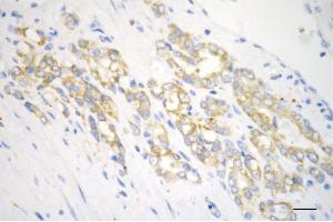 Immunohistochemistry was performed on paraffin-embedded human prostatic adenocarcinoma using collagen type III alpha 1 chain antibody (ABIN7798126), 1:200).