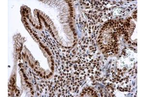 IHC-P Image ALY antibody detects ALY protein at nucleus in human esophageal cancer by immunohistochemical analysis.