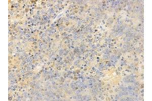 ABIN6255342 and ABIN6267387 at 1/100 staining human melanoma by IHC-P.
