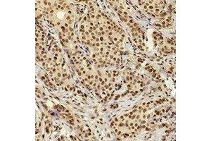 Immunohistochemical analysis of XRCC4 staining in human breast cancer formalin fixed paraffin embedded tissue section.