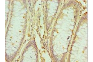 Immunohistochemistry of paraffin-embedded human colon cancer using ABIN7155133 at dilution of 1:100