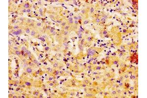 IHC image of ABIN7146723 diluted at 1:100 and staining in paraffin-embedded human liver cancer performed on a Leica BondTM system. (CA4 Antikörper  (AA 75-200))