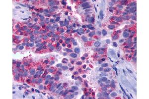 Anti-GPR137B antibody IHC of human Ovary, Carcinoma. (GPR137B Antikörper  (Cytoplasmic Domain))