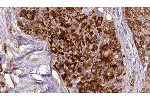 ABIN6272677 at 1/100 staining Human liver cancer tissue by IHC-P. (Calcitonin Receptor Antikörper  (N-Term))