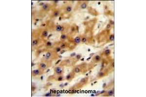 GAGE13 Antibody (N-term) (ABIN654525 and ABIN2844247) immunohistochemistry analysis in formalin fixed and paraffin embedded human hepatocarcinoma followed by peroxidase conjugation of the secondary antibody and DAB staining. (G Antigen 13 Antikörper  (N-Term))