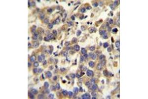 Immunohistochemistry analysis in formalin fixed and paraffin embedded human testis carcinoma reacted with  LYPD4 Antibody (Center) followed which was peroxidase conjugated to the secondary antibody and followed by DAB staining. (LYPD4 Antikörper  (Middle Region))