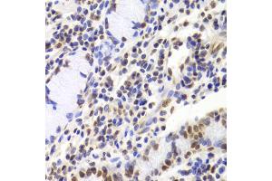 Immunohistochemistry of paraffin-embedded human gastric cancer using XRCC5 Antibody.