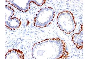 Formalin-fixed, paraffin-embedded human Prostate Carcinoma stained with p40 Rabbit Polyclonal Antibody. (p63 Antikörper  (AA 5-17))