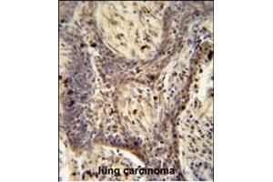 RC1 antibody (C-term) (ABIN654964 and ABIN2844603) immunohistochemistry analysis in formalin fixed and paraffin embedded human lung carcinoma followed by peroxidase conjugation of the secondary antibody and DAB staining. (PPRC1 Antikörper  (C-Term))