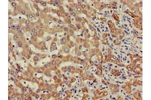 Immunohistochemistry of paraffin-embedded human liver cancer using ABIN7171195 at dilution of 1:100 (SDC4 Antikörper  (AA 19-145))